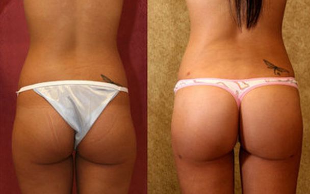 Brazilian Butt Lift Before & After Image 1