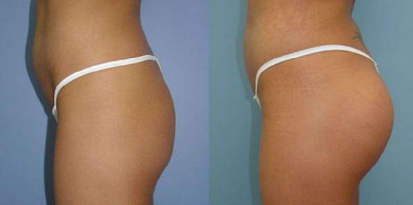 Brazilian Butt Lift Before & After Image 2