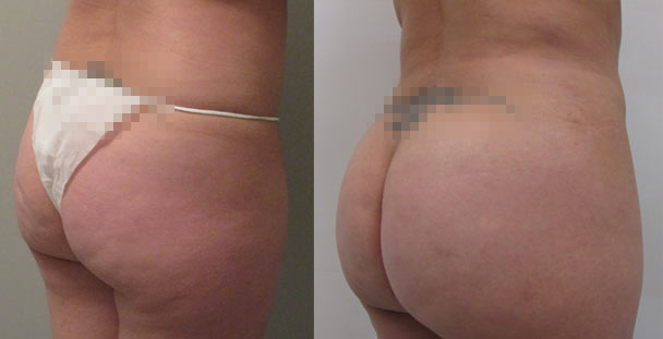 Brazilian Butt Lift Before & After Image 5