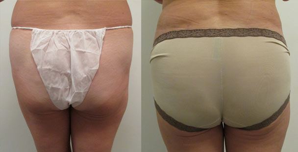 Brazilian Butt Lift Before & After Image 7